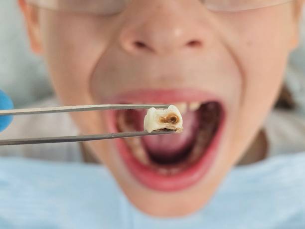 Best Emergency Wisdom Teeth Removal in Grand Saline, TX