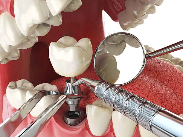 Best Emergency Tooth Extraction in Grand Saline, TX